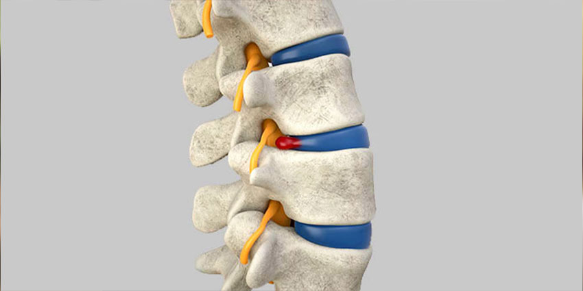 patient needing herniated disc chiropractor in Wilmington